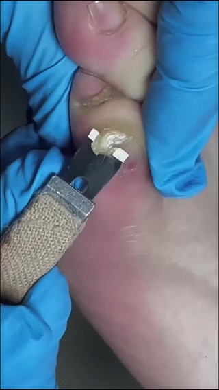 足球鞋磨大脚趾(足球鞋磨大脚趾怎么办)