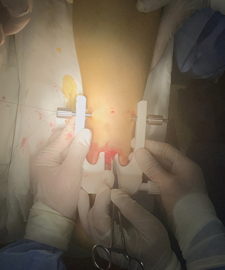 足球跟腱挤压(跟腱被压了走路疼怎么办)  第2张